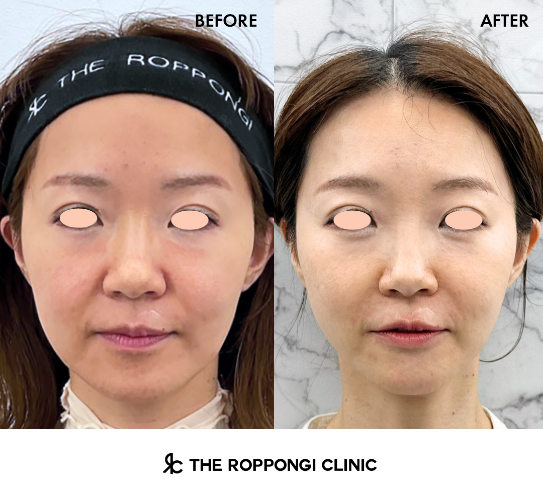 別人級の小顔術