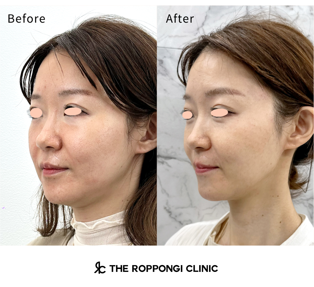 小顔治療、脂肪溶解注射、糸リフト