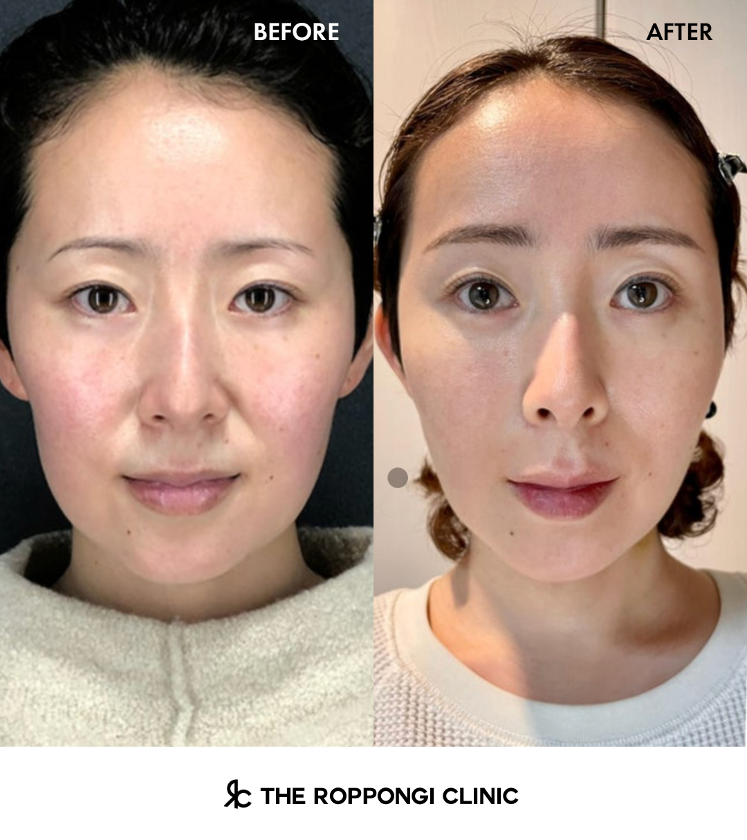 ザロク式強力!脂肪溶解注射でスッキリ