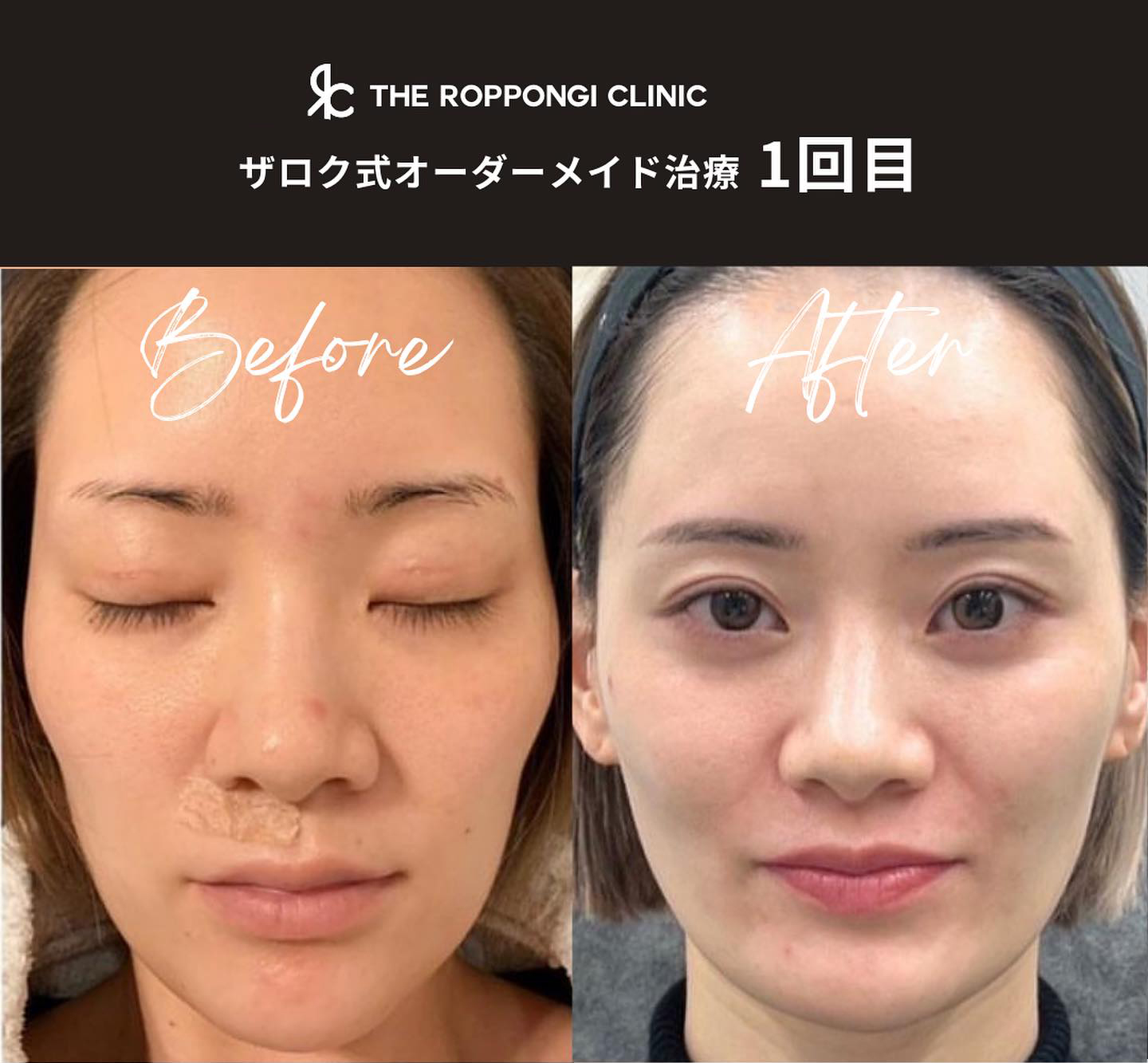 ザロク式オーダーメイド治療【骨切り無しでここまでの変化】