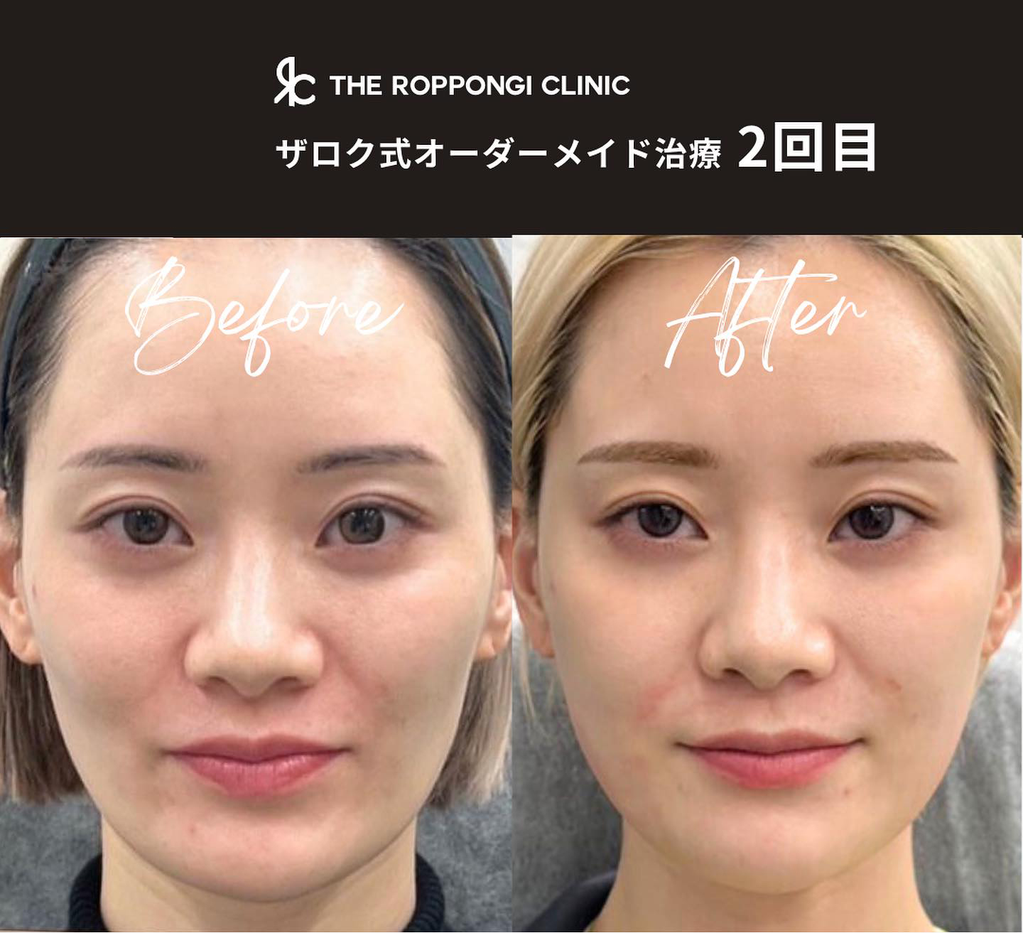 小顔治療、ヒアルロン酸、脂肪溶解注射、ボトックス注入