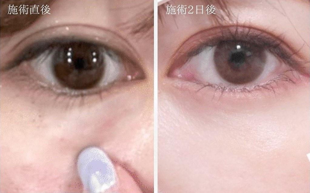 スネコスで年齢が出る目元を集中ケア