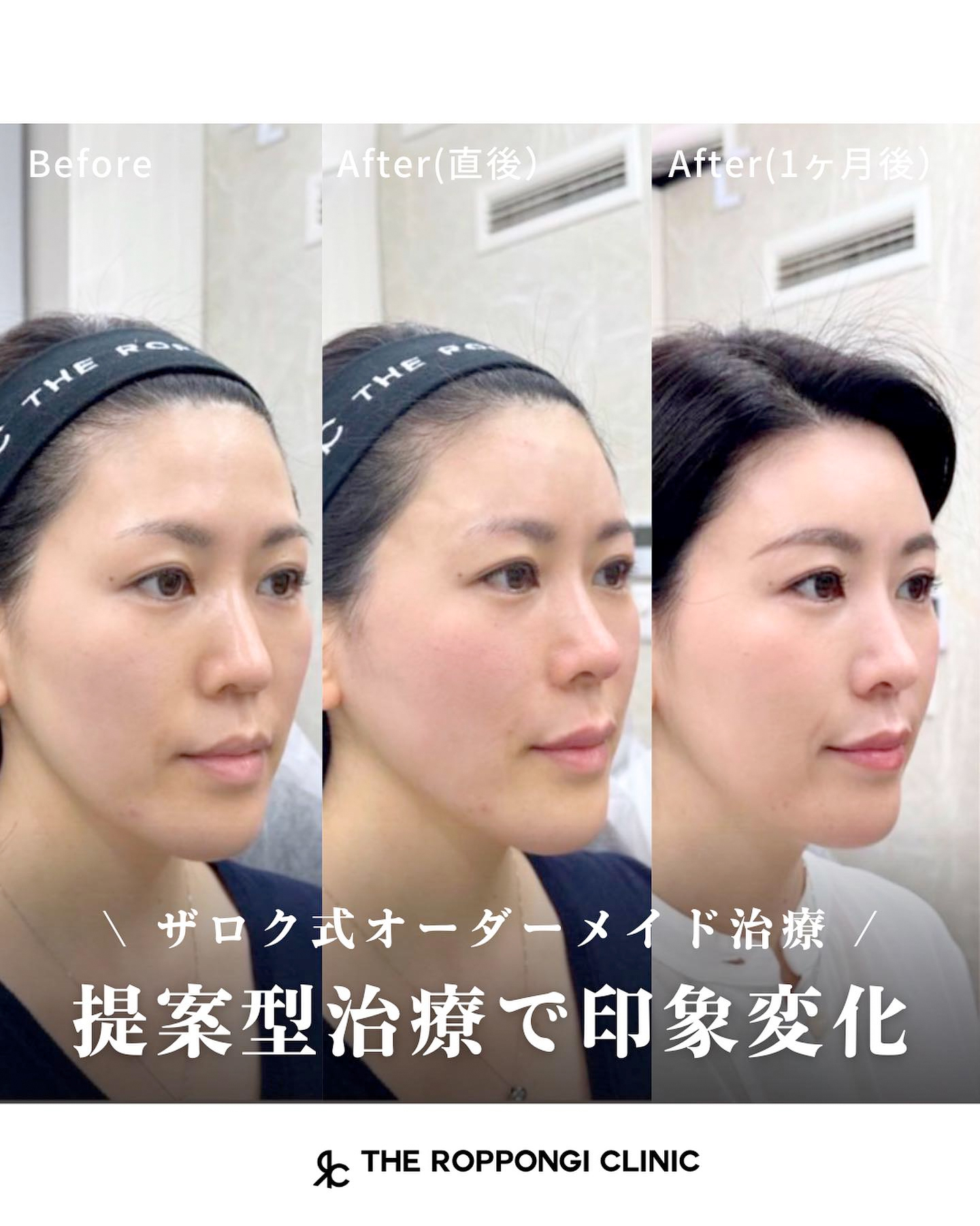 ザロク式似合わせヒアルロン酸®︎と糸リフトで若々しいお顔へ