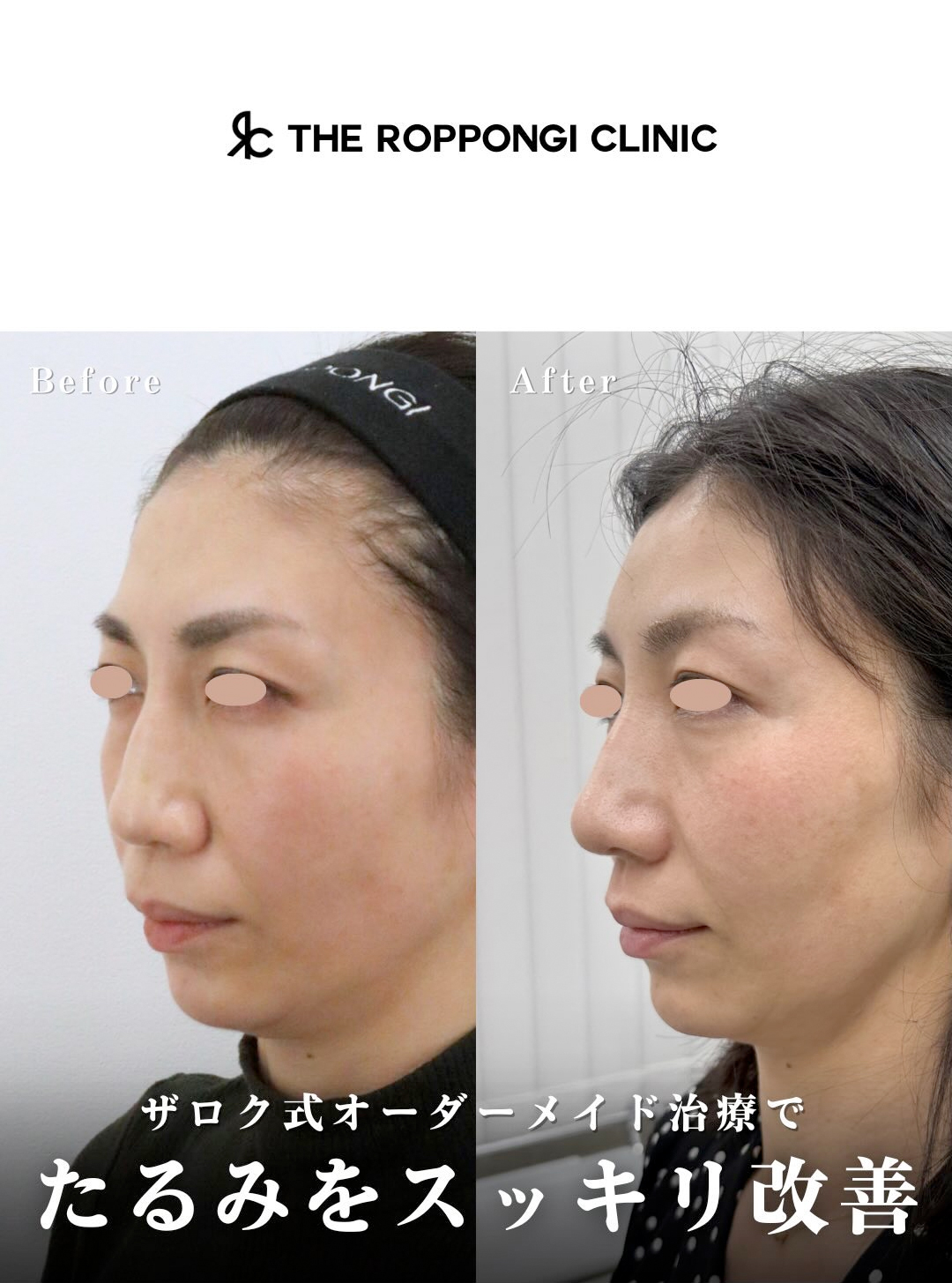 ザロク式オーダーメイド治療でたるみをスッキリ改善