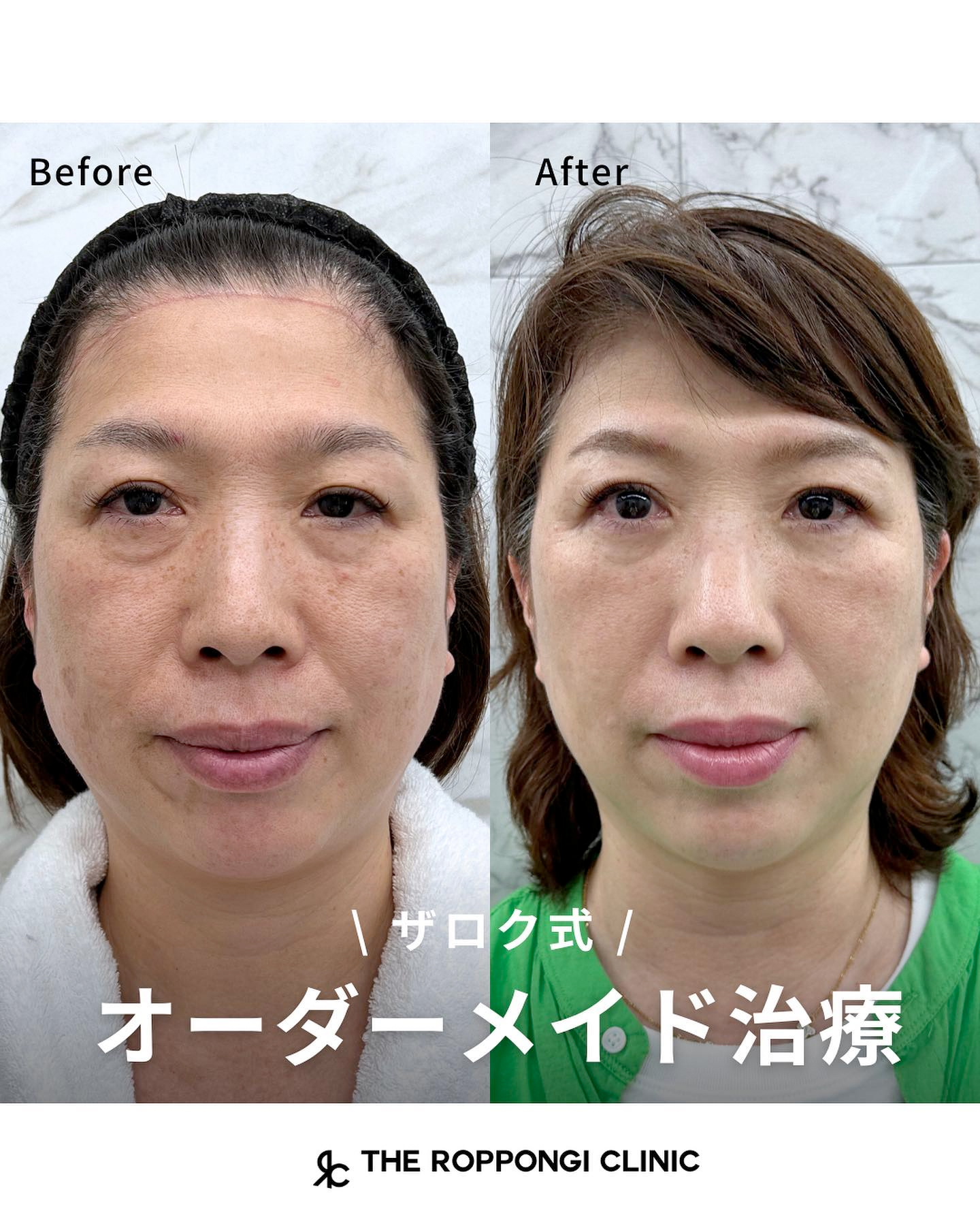 【ザロク式オーダーメイド治療】脱脂+ザロク式似合わせヒアルロン酸®︎