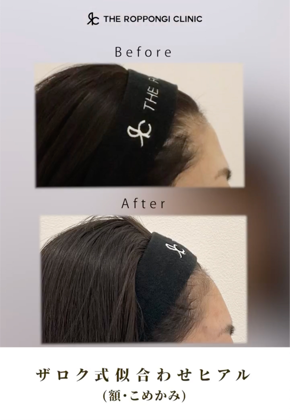 たるみ、シワ、ヒアルロン酸注射