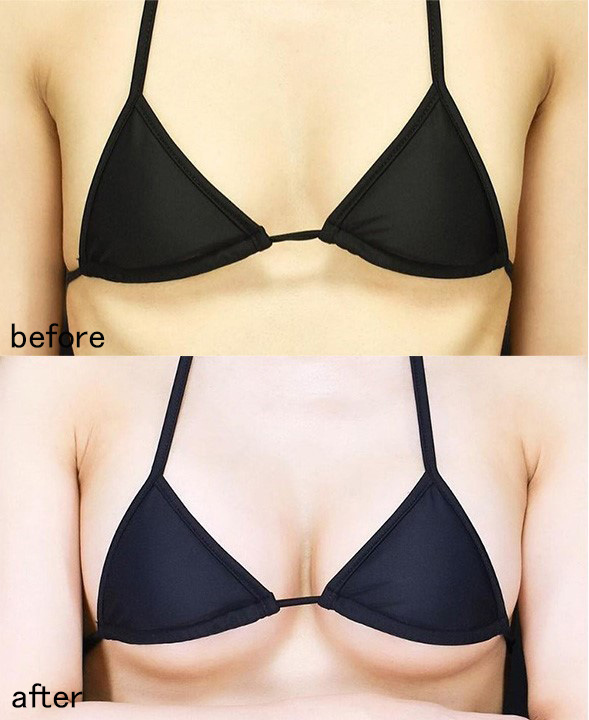 ザロク式ナチュラル美バスト(ナチュラルバッグ豊胸)