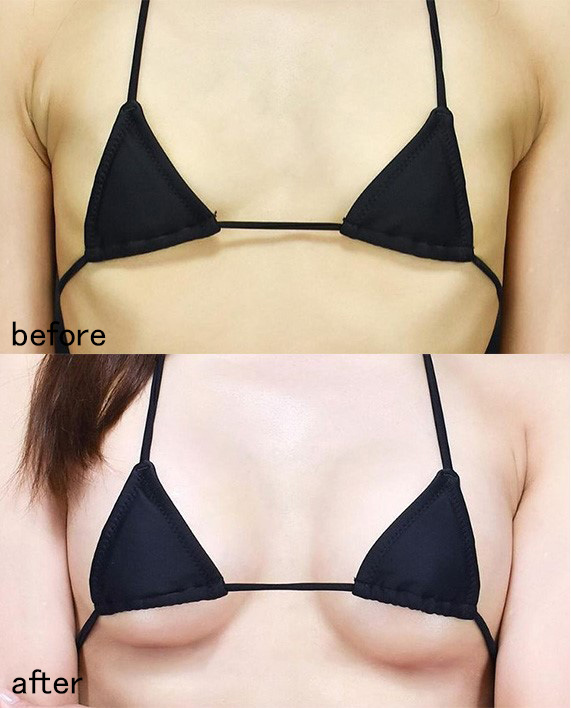 ザロク式ナチュラル美バスト(ナチュラルバッグ豊胸)