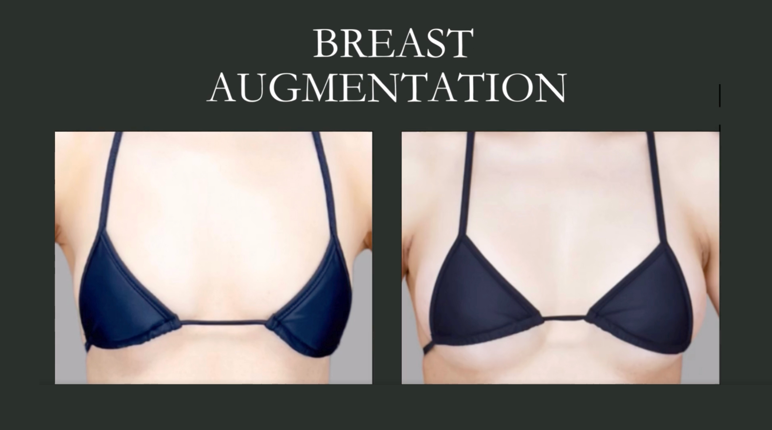 シリコンバッグ豊胸