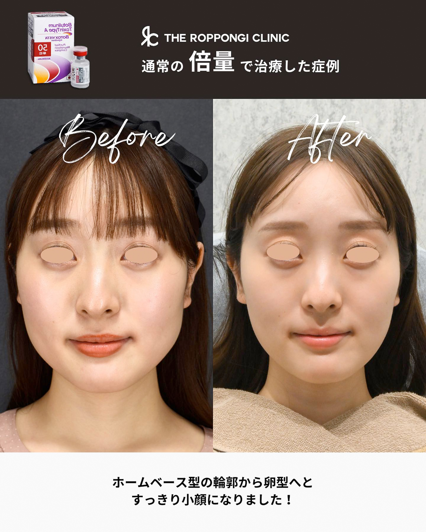 エラボトックスで小顔に!