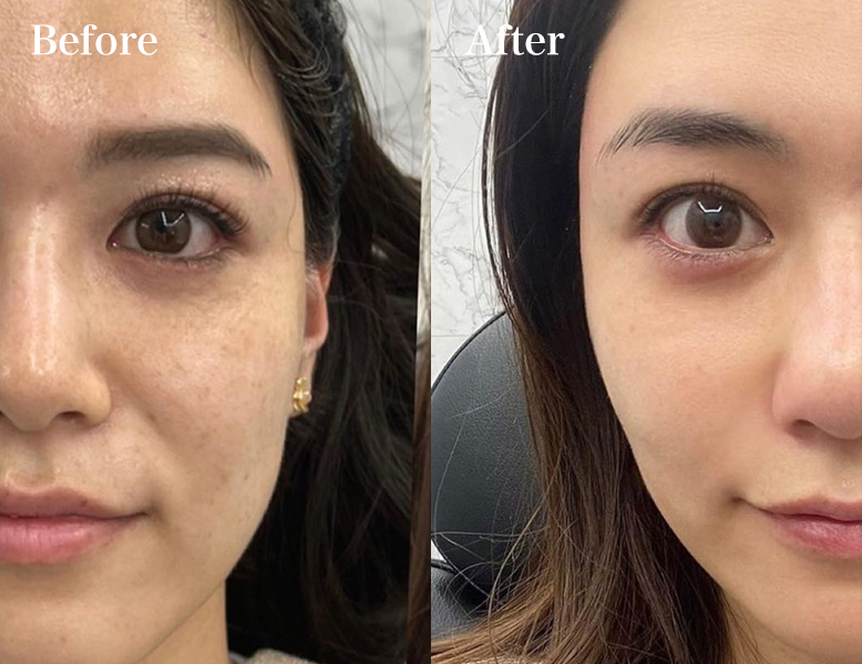 ヒアルロン酸でゴルゴ線を改善