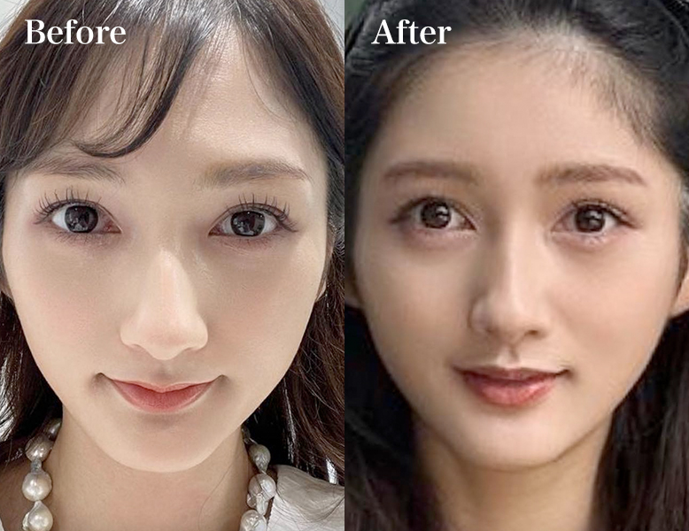 ヒアルロン酸による涙袋形成