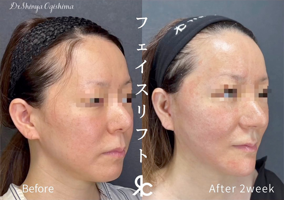 切開によるフェイスリフト