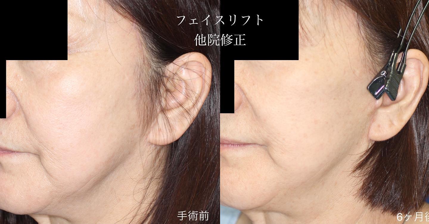 フェイスリフトの他院修正