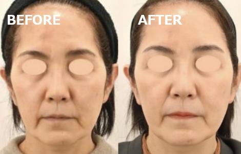 ハリツヤエランセによるハリツヤ改善