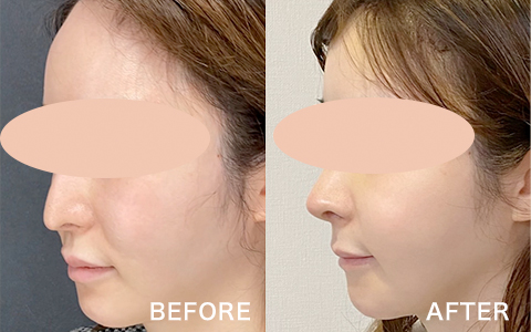 広い額にお悩みの方に額縮小術