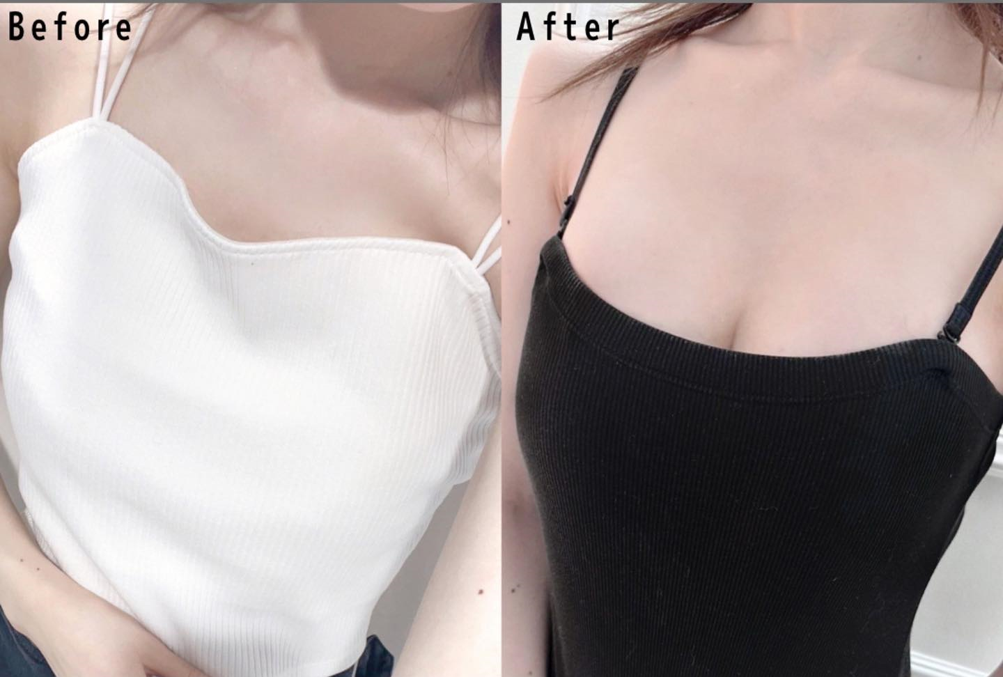 脂肪豊胸+シリコンバッグ豊胸で自然な谷間を