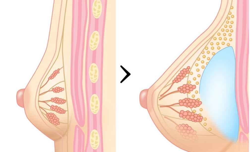 ハイブリッド豊胸