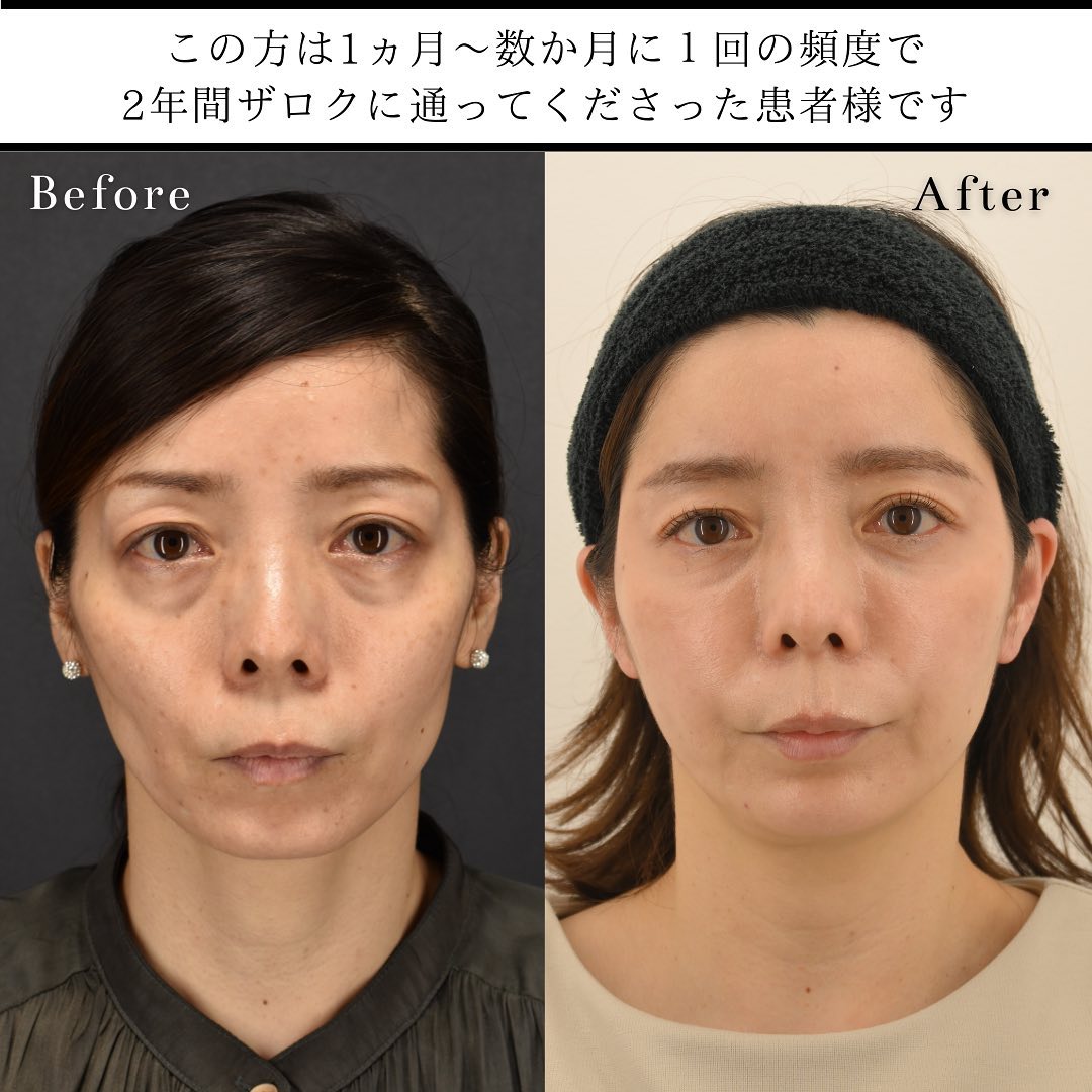 ヒアルロン酸による若返り