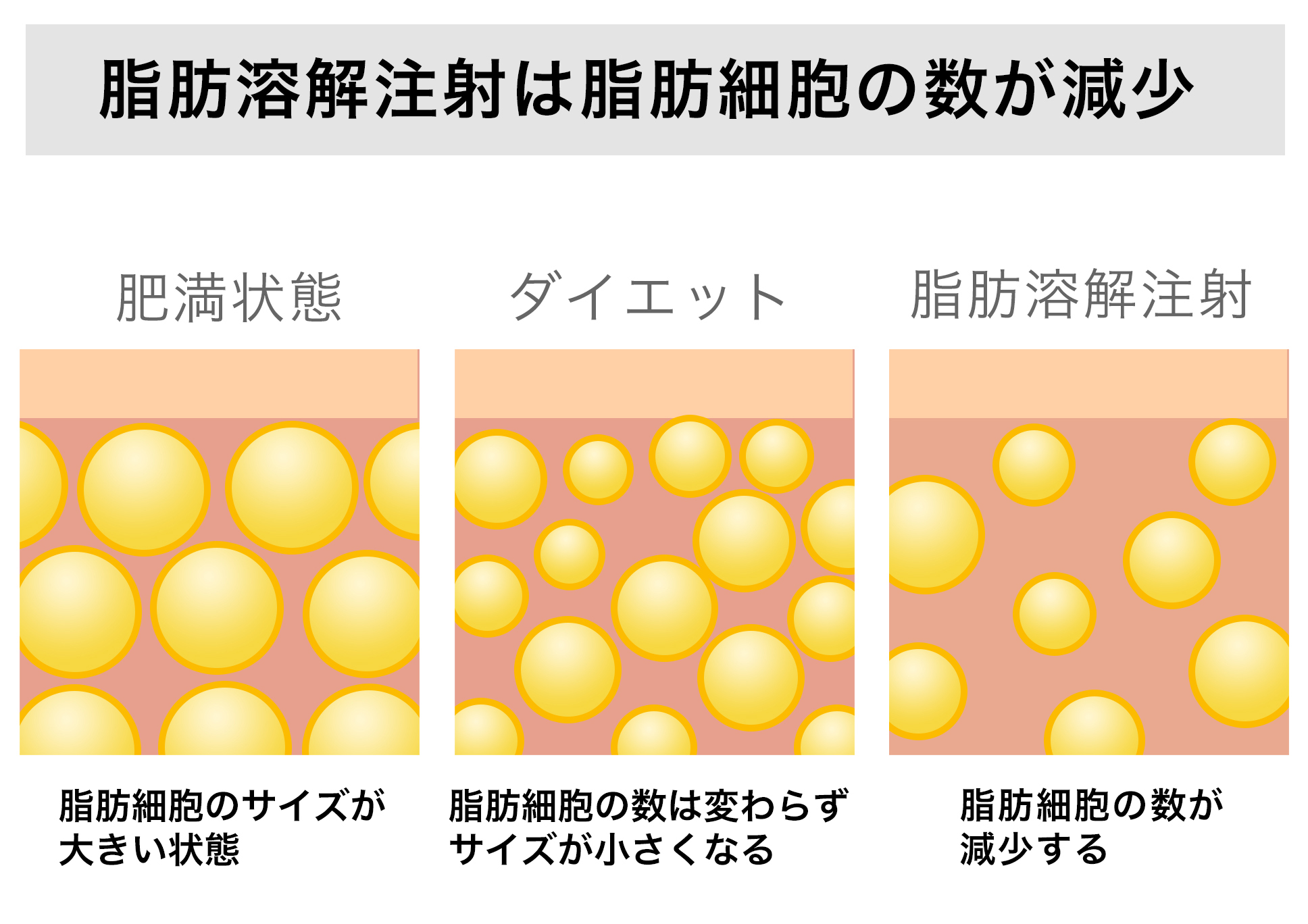 脂肪溶解注射は脂肪細胞の数が減少する