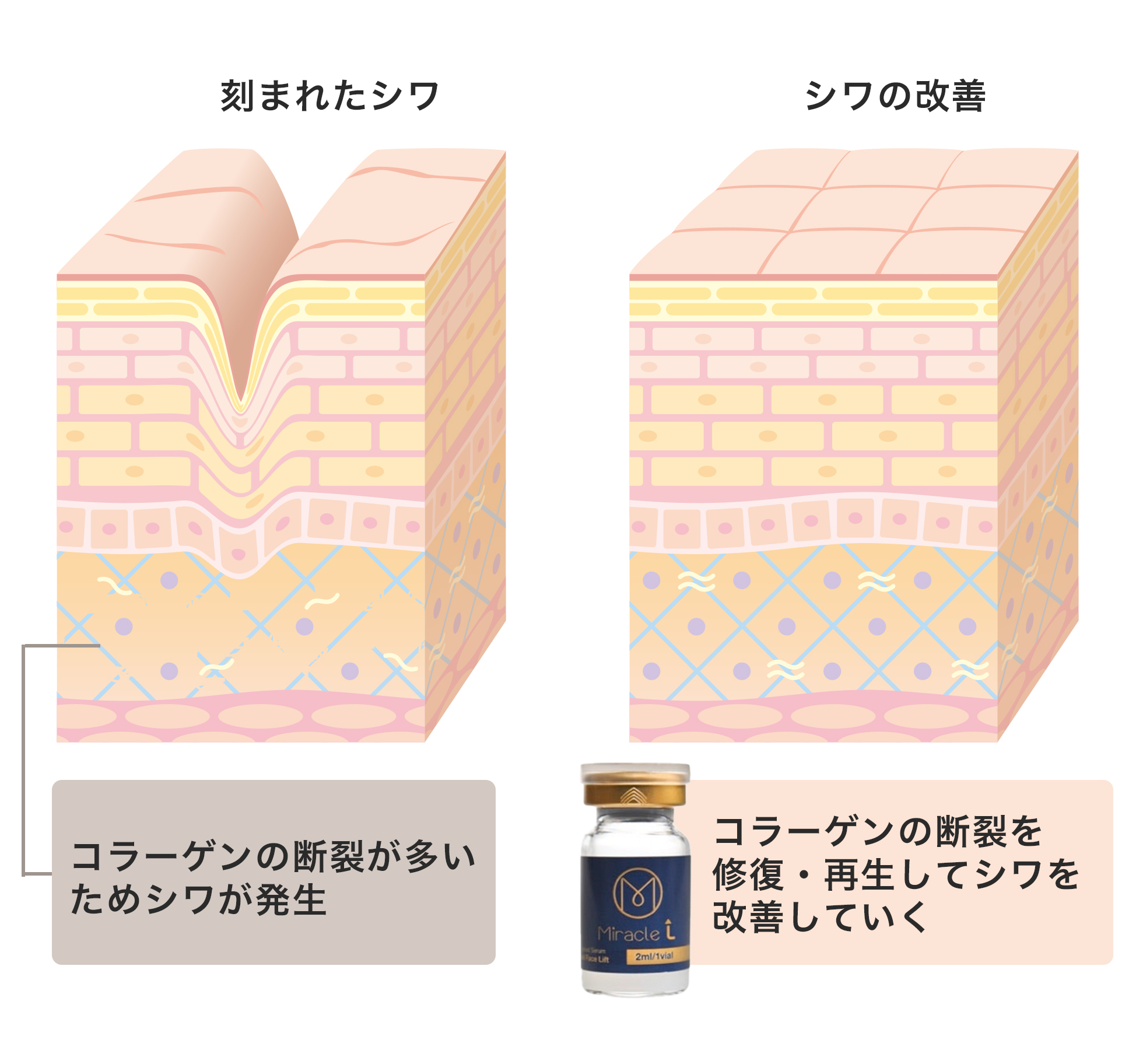 ミラクルLによるシワの改善