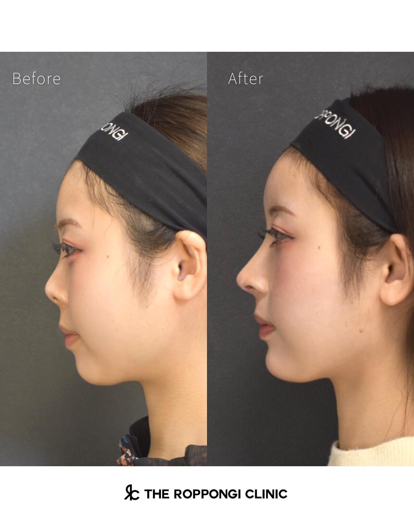 鼻整形、鼻中隔湾曲矯正