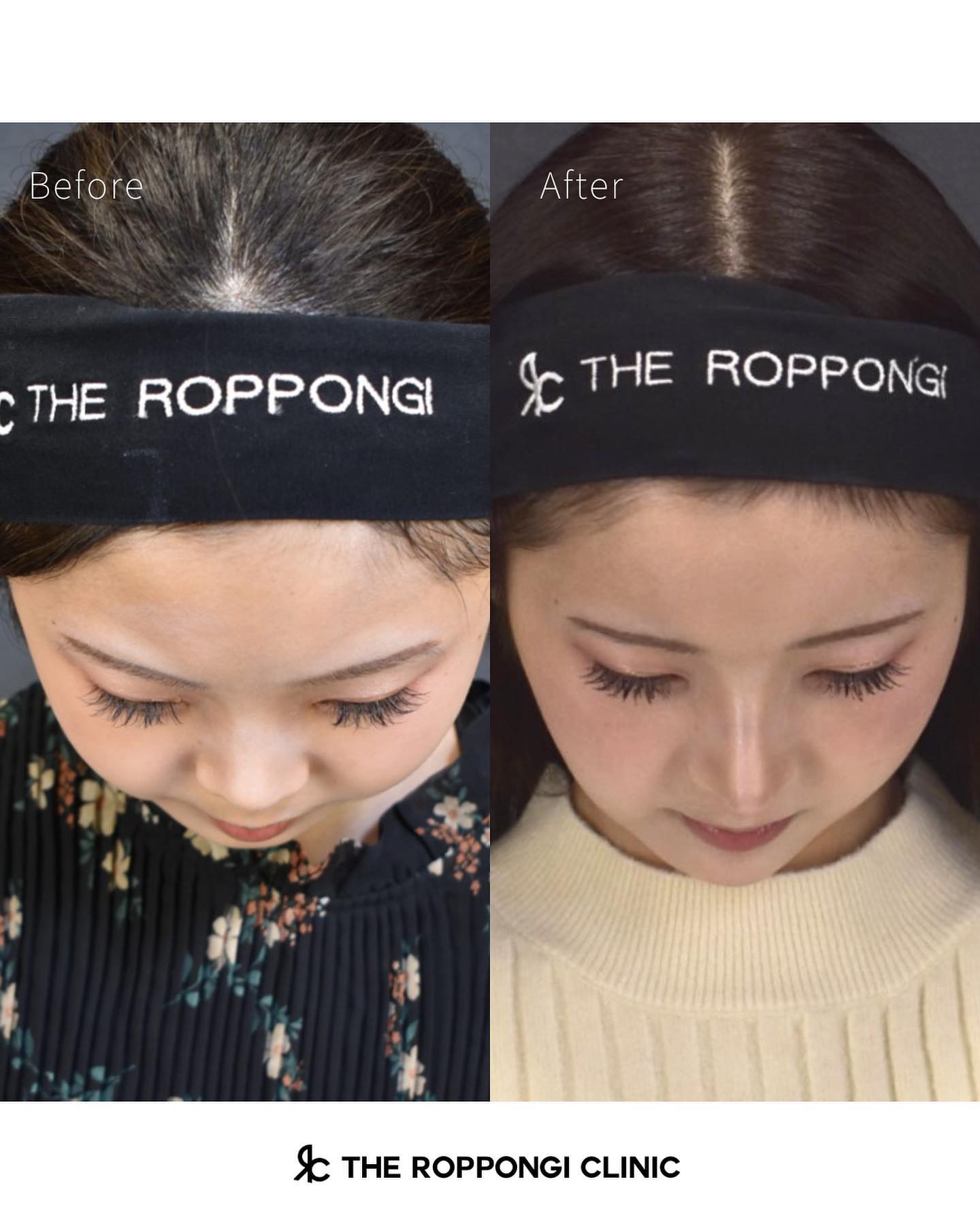 鼻整形、鼻中隔湾曲矯正