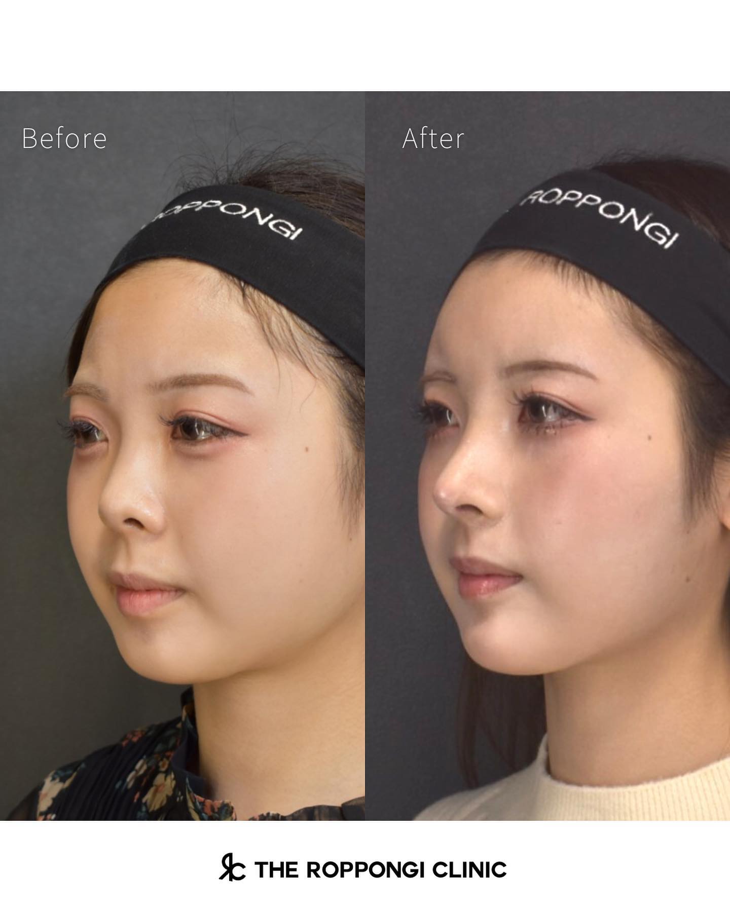 鼻整形、鼻中隔湾曲矯正