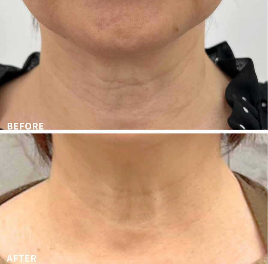 プロファイロによる首シワ改善