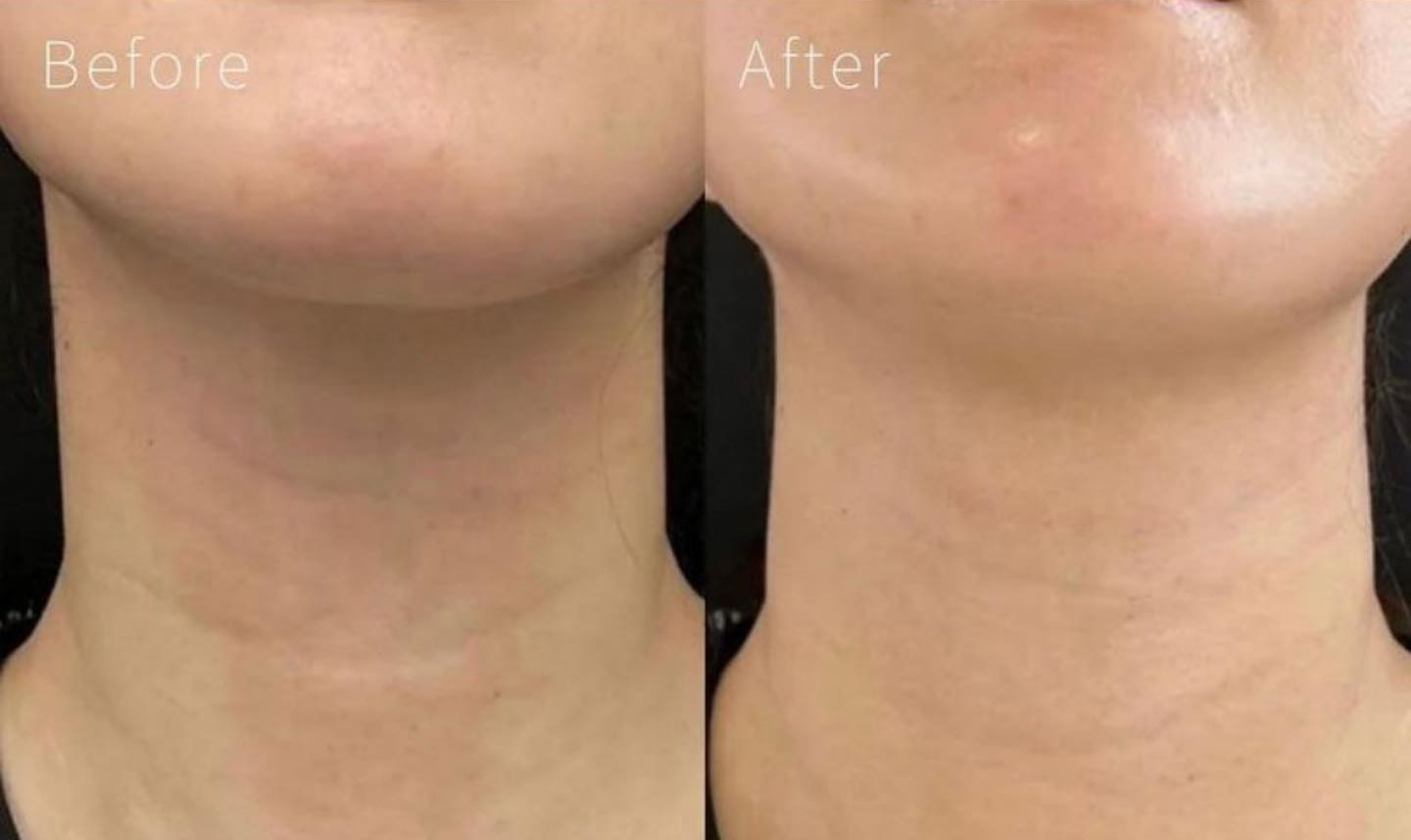 プロファイロによる首シワ改善