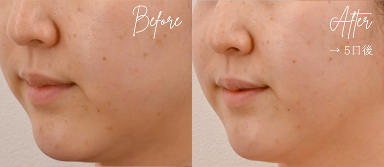 水光ショットでお肌をうる艶肌に