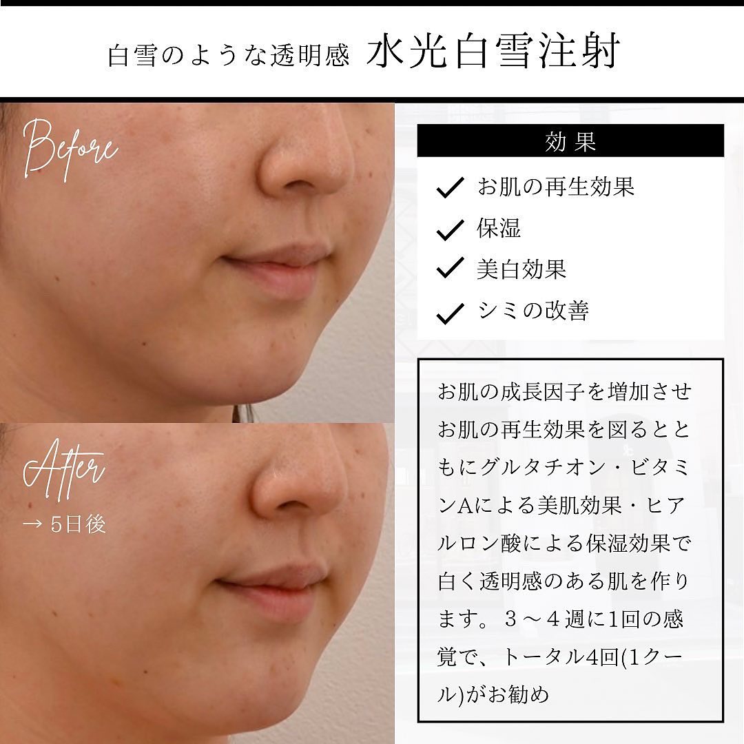 水光ショット(U225)