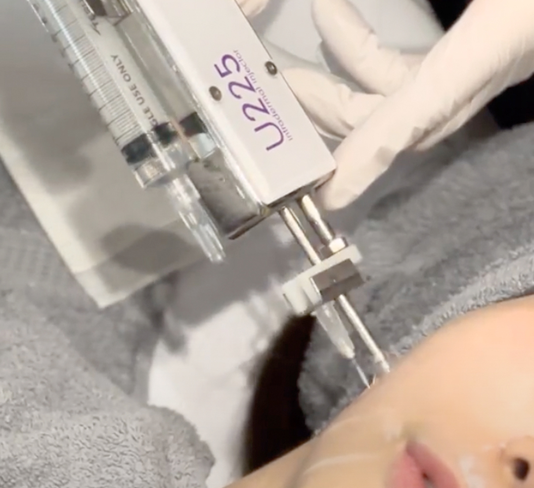 水光ショット(U225)