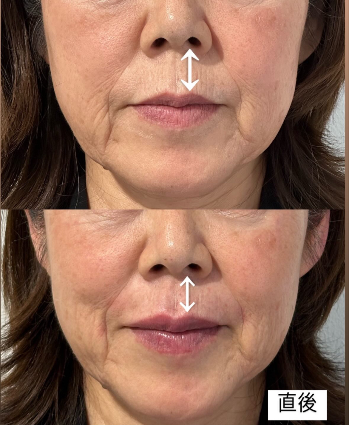 切らずに人中短縮で若々しく!