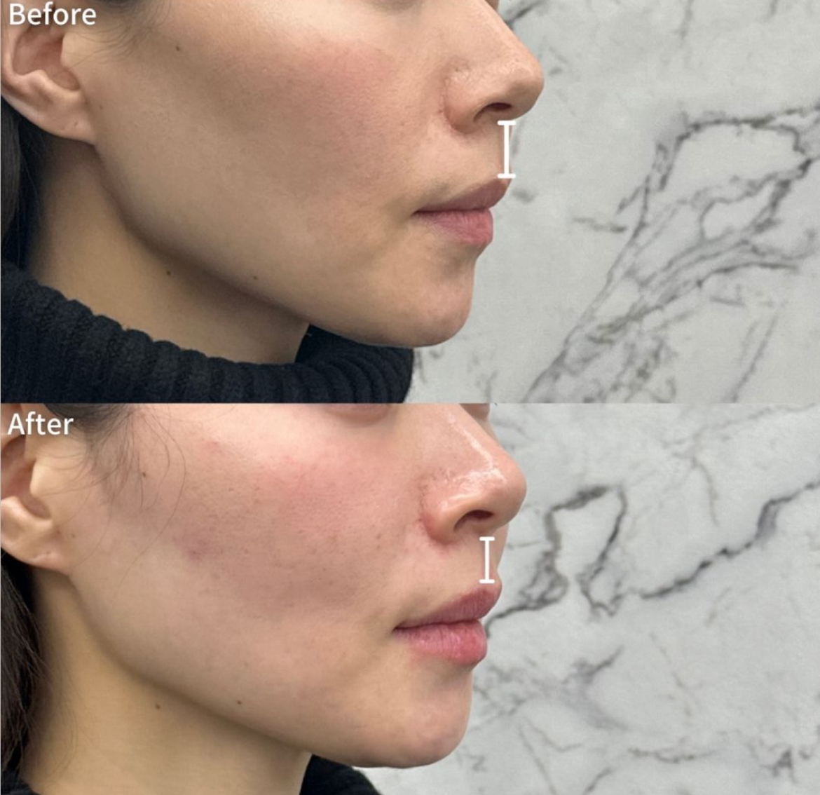 切らない人中短縮でお顔の黄金比に!