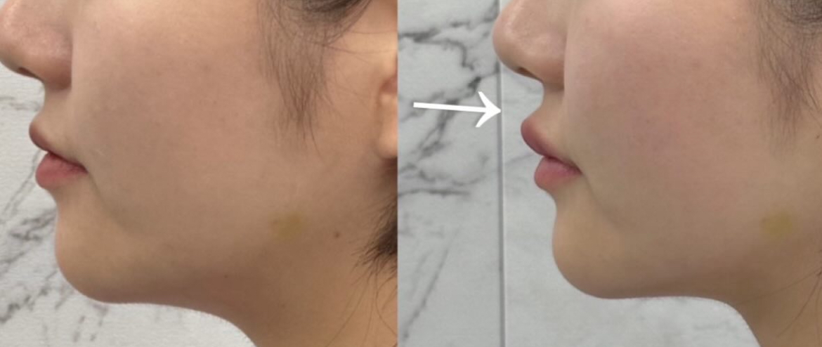 人中短縮とCカールリップを叶える