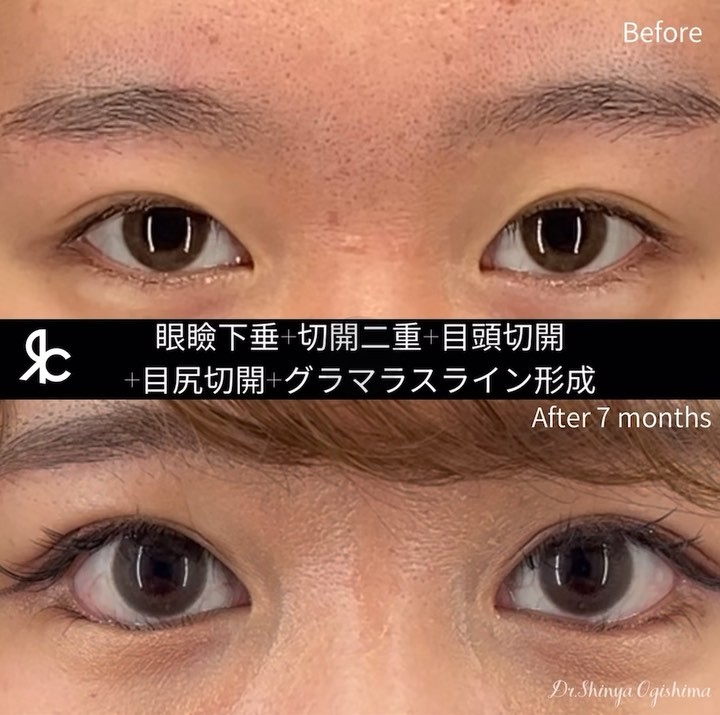 眼瞼下垂手術＋全切開二重＋目頭切開＋目尻切開＋グラマラスライン形成術