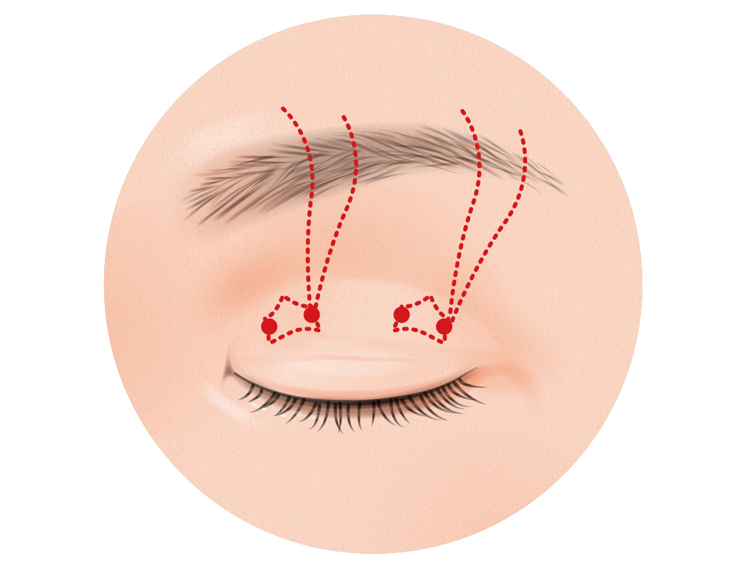 二重まぶた埋没法
