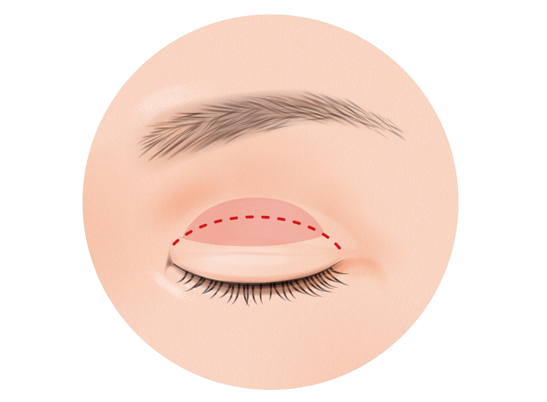 二重まぶた全切開法