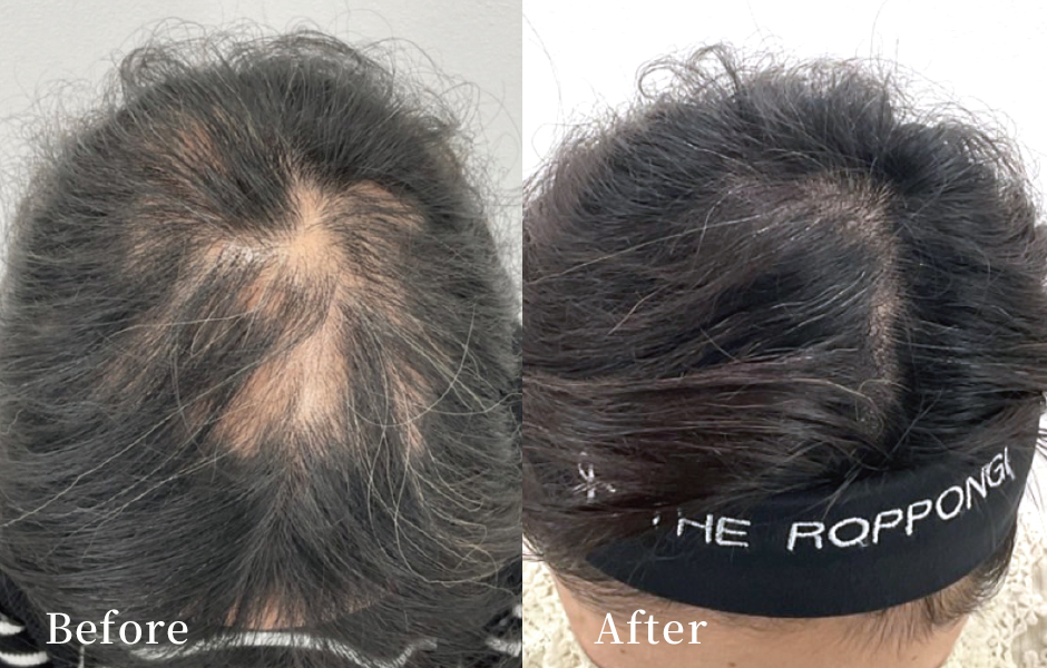 女性の薄毛治療