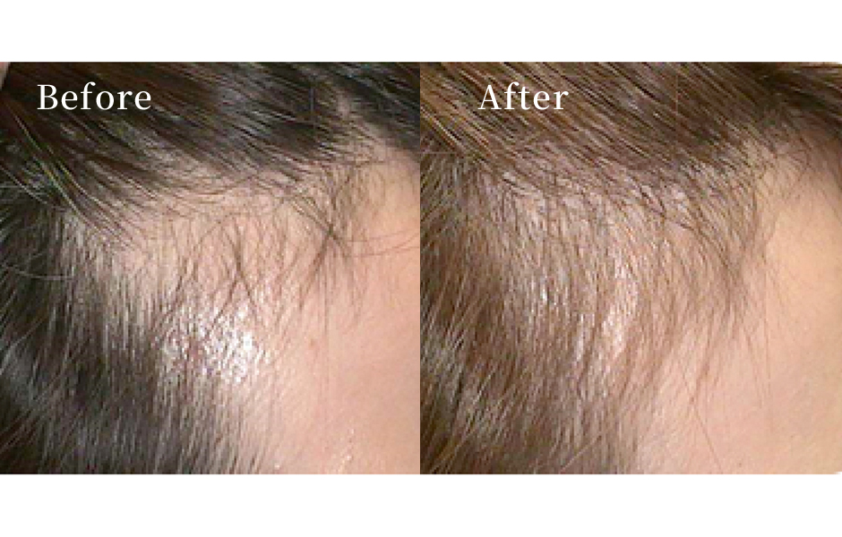 女性の薄毛治療（ヘアフィラー）