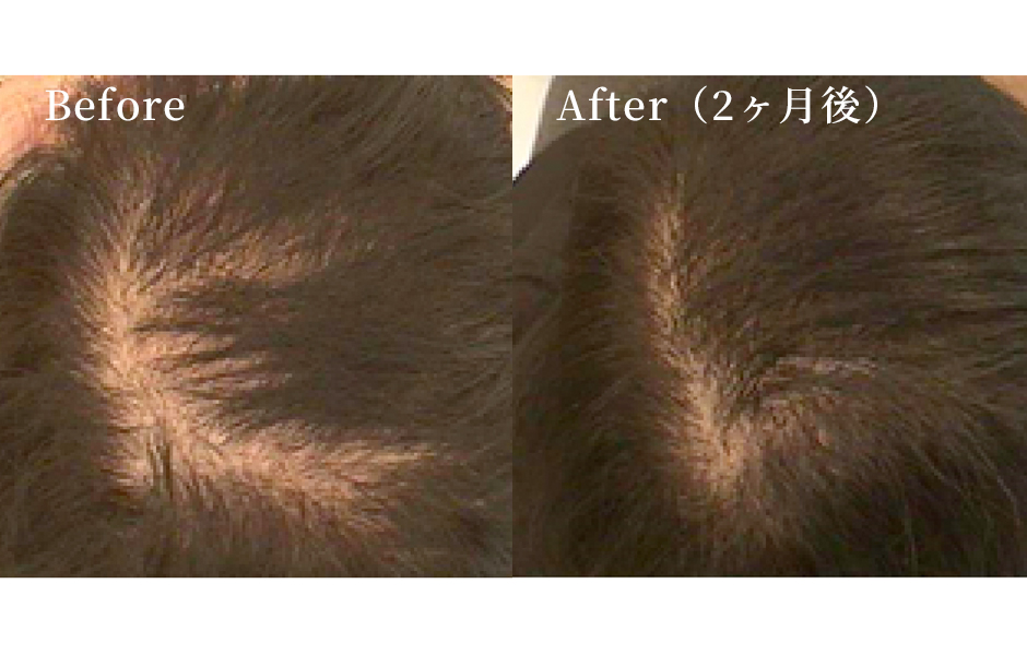 女性の薄毛治療（ヘアフィラー）