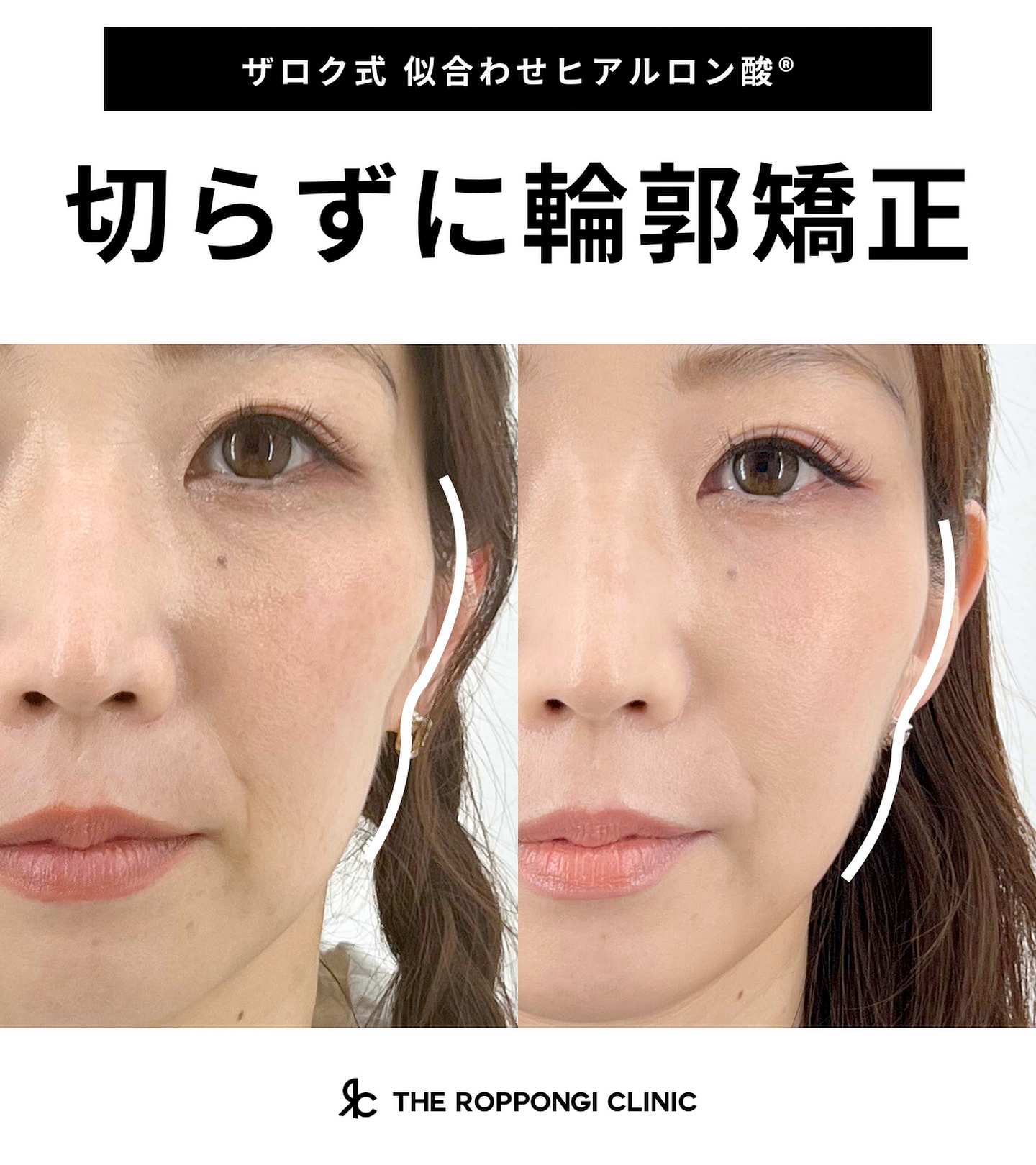 切らずに輪郭矯正(ヒアルロン酸)