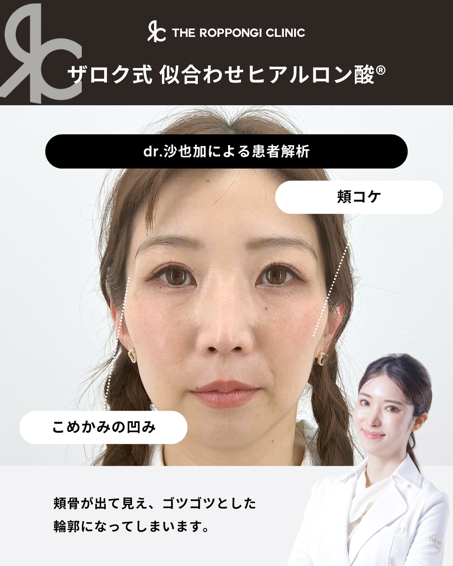 ヒアルロン酸で切らずに輪郭形成