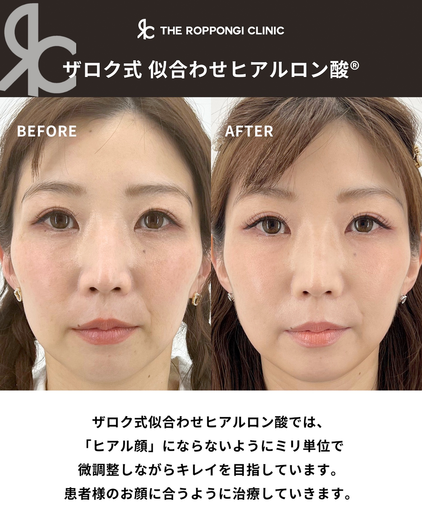 ヒアルロン酸で切らずに輪郭形成