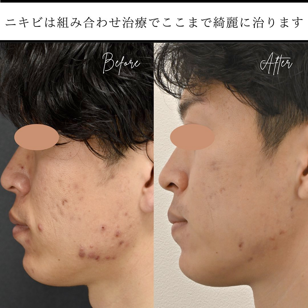 ニキビ治療