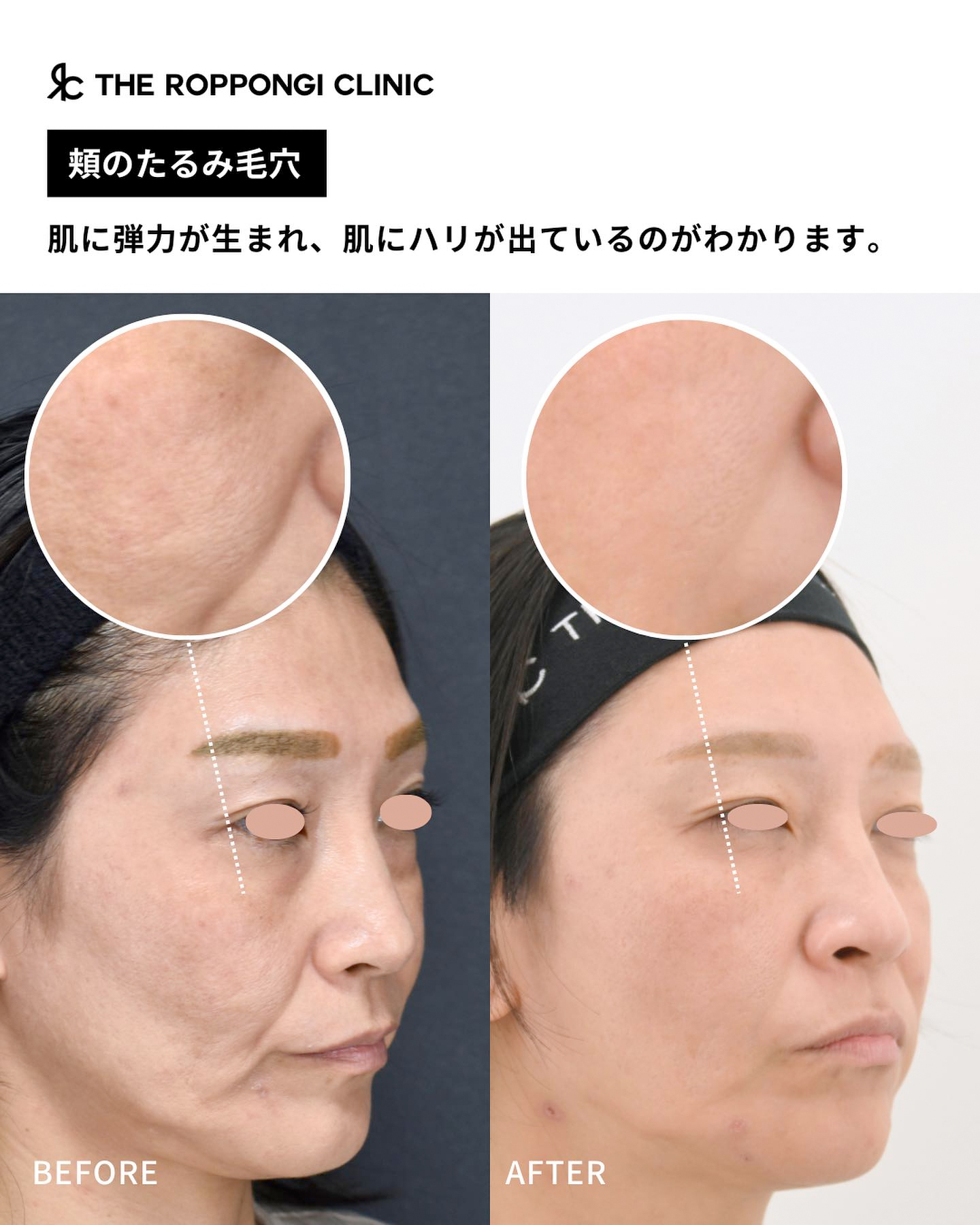 ピコフラクショナル治療（頬のたるみ毛穴）