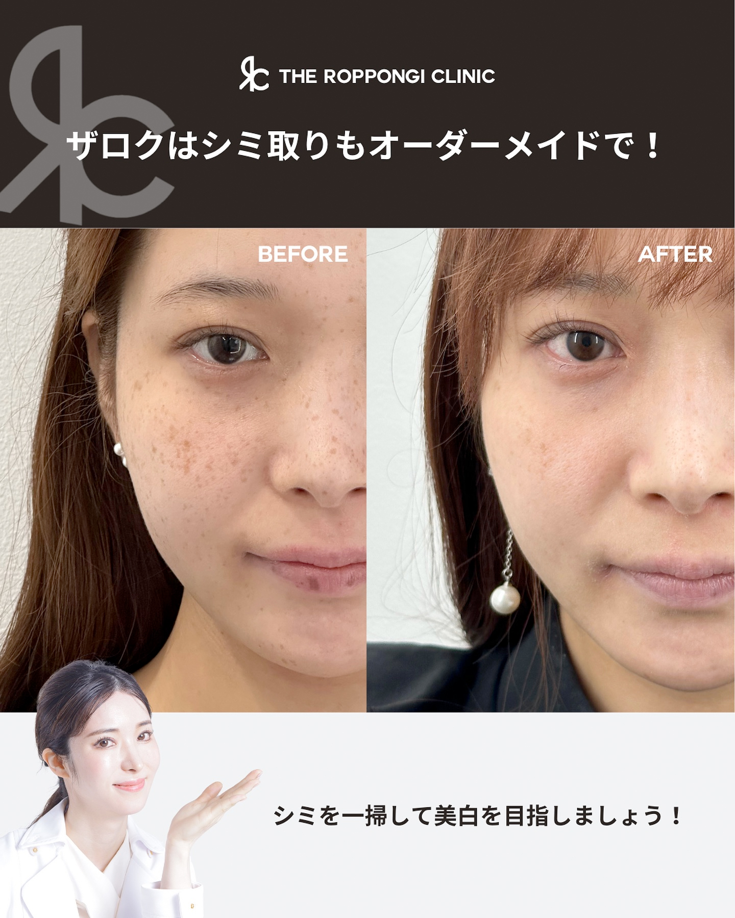 シミ取り(ピコレーザー)