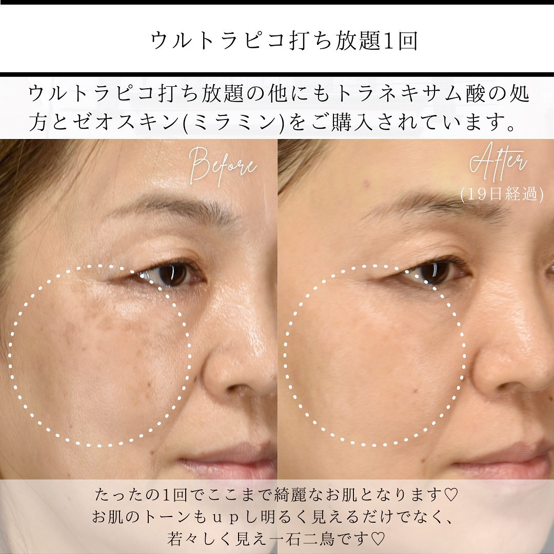 シミ治療(ピコレーザー)