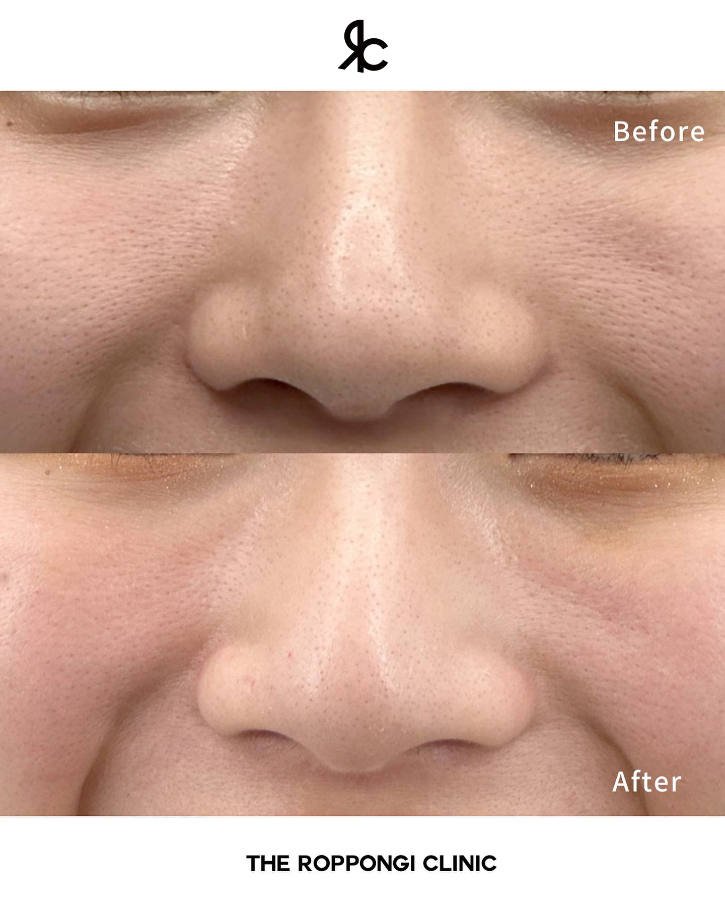 1回でも実感！ザロクの毛穴治療